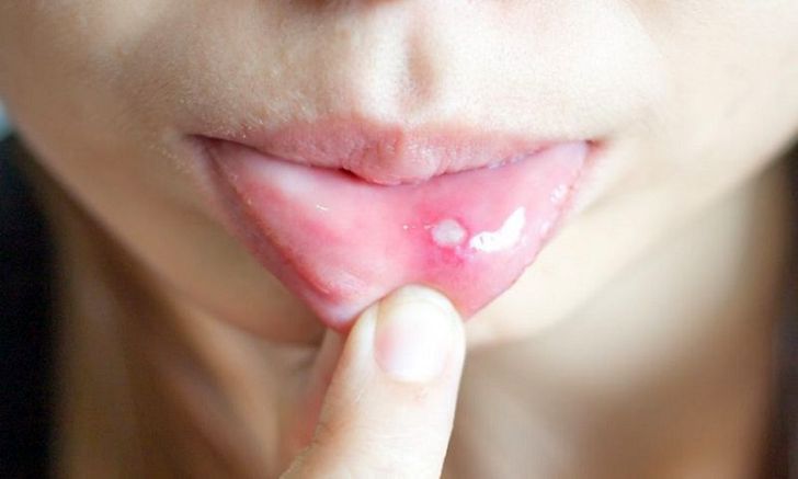 چگونه آفت دهان را درمان کنیم