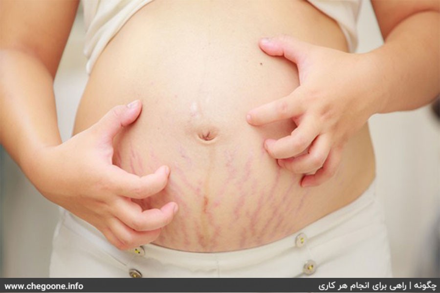 چگونه از ایجاد ترک های پوستی بارداری جلوگیری کنیم