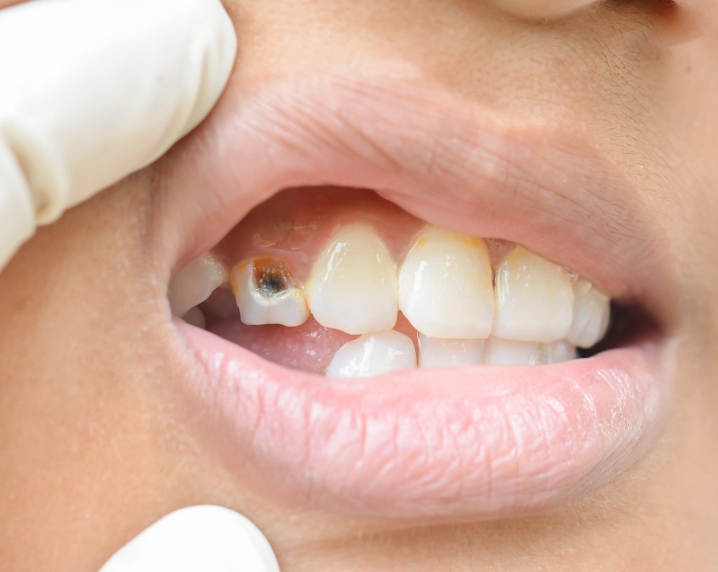 درمان‌های خانگی دندان درد + 7 راه درمان سریع درد دندان